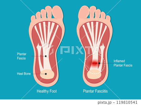 Plantar fasciitis is one of the most common orthopedic. 119810541