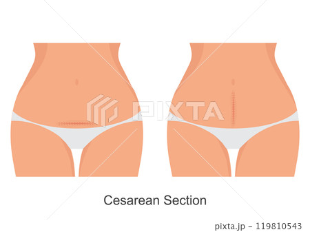 Caesarean section also known as C section. Caesarean section also known as C section. 119810543