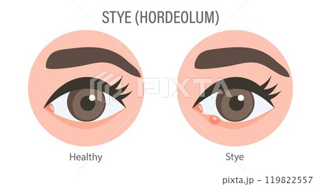 External and internal stye of the eye. Medical concept of stye, eye pain, bacterial infection, eye disease. Flat illustration, infographic banner External and internal stye of the eye. Medical concept of stye, eye pain, bacterial infection, eye disease. Flat illustration, infographic banner 119822557