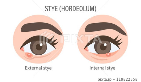 External and internal stye of the eye. Medical concept of stye, eye pain, bacterial infection, eye disease. Flat illustration, infographic banner 119822558