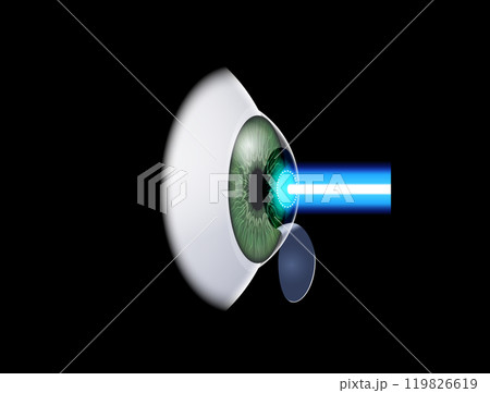 LASIK eye surgery 119826619