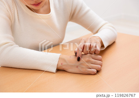 ノミに噛まれた女性の手元 119826767