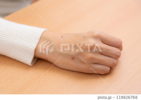 ノミに噛まれた女性の手元 119826768