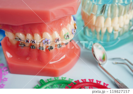 Orthodontic ligatures rings and ties, elastic rubber bands on orthodontic braces, model for dentist studying about dentistry. 119827157
