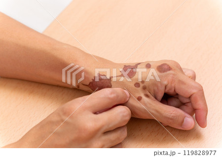 やけど跡 119828977