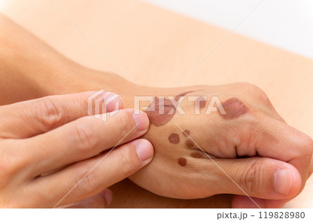 やけど跡 119828980
