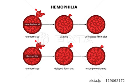 Hemophilia medical poster 119862172