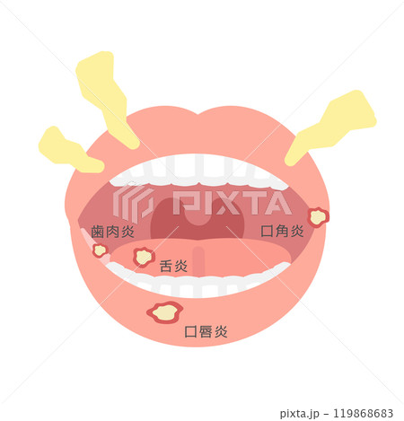口内炎 種類 イラスト 口内炎 種類 イラスト 119868683