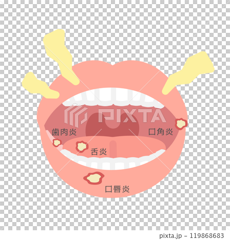 口内炎 種類 イラスト 口内炎 種類 イラスト 119868683