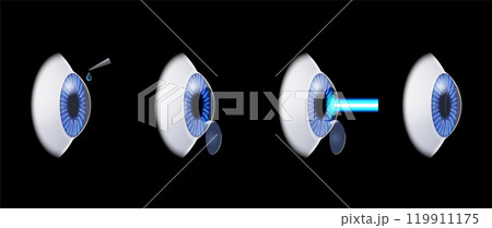 LASIK eye surgery LASIK eye surgery 119911175