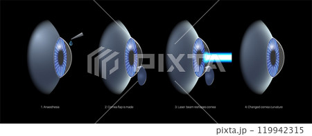 LASIK eye surgery 119942315