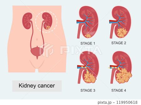 The stage describes how much cancer is in the body. 119950618