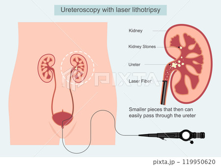 Ureteroscopy with laser lithotripsy is used to break up kidney stones. 119950620