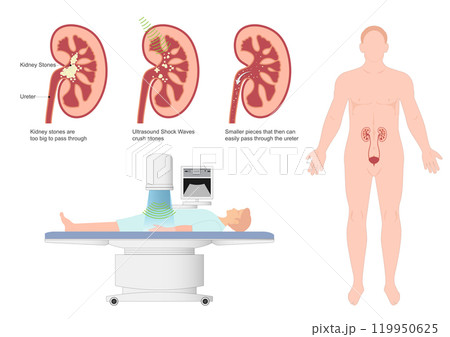 Extracorporeal Shock Wave Lithotripsy (ESWL) is the use. Extracorporeal Shock Wave Lithotripsy (ESWL) is the use. 119950625