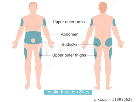Human outlines showing injection sites on front. Human outlines showing injection sites on front. 119950628