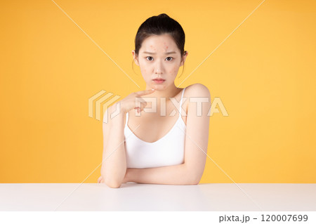 Teenage woman using ointment to remove skin problems on her face 120007699