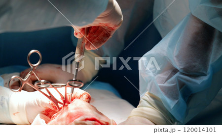 Close up of surgical tools being used by surgeons during a complex operation, highlighting the precision and expertise required in the medical field 120014101