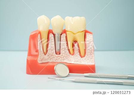 Dental implant, artificial tooth roots into jaw, root canal of dental treatment, gum disease, teeth model for dentist studying about dentistry. 120031273