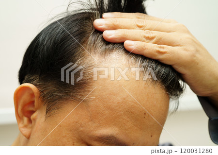Bald head in man, hair loss treatment health problem. 120031280