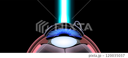 LASIK eye surgery 120035037