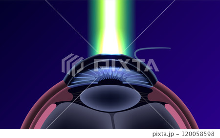 LASIK eye surgery 120058598