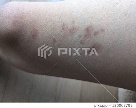 太ももについたアザ 120062795
