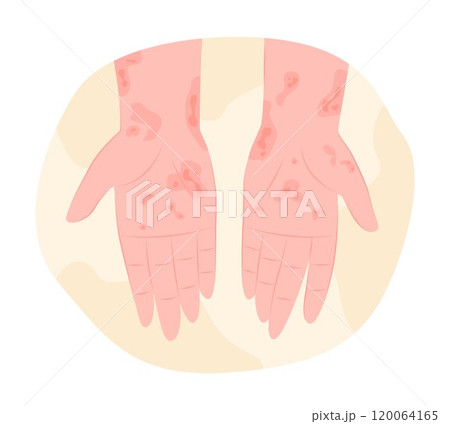 Eczema or Skin Rashes on Human Hands for Dermatology Concept Illustration 120064165