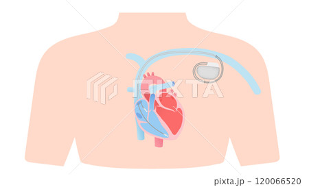 心臓に取り付けられたペースメーカーのイラスト 120066520