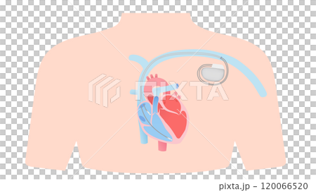 心臓に取り付けられたペースメーカーのイラスト 120066520