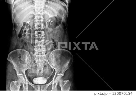 Black and white torso X-ray film image 120070154