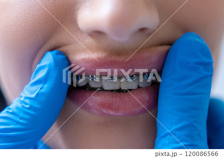 Unrecognizable dentist wearing protective gloves examining patient’s teeth and braces 120086566