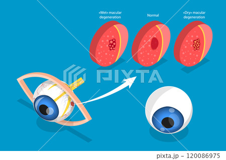 3D Isometric Flat Vector Illustration of Age-related Macular Degeneration, Eye Illness, Sight Problem 3D Isometric Flat Vector Illustration of Age-related Macular Degeneration, Eye Illness, Sight Problem 120086975