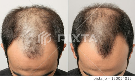 Before and After Images of Men Hairline Improvement 120094013