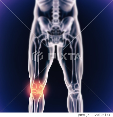 When inflammation strikes. A cgi view of an inflamed joint isolated on blue. When inflammation strikes. A cgi view of an inflamed joint isolated on blue. 120104173