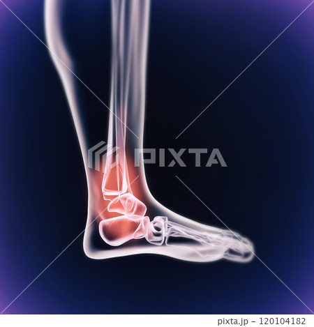 When inflammation strikes. A cgi view of an inflamed joint isolated on blue. When inflammation strikes. A cgi view of an inflamed joint isolated on blue. 120104182