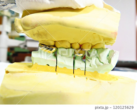 Gold Crown bite 120125629