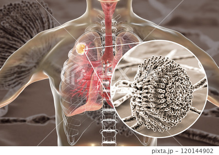 Aspergilloma of the lung 120144902