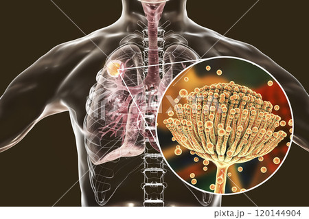 Aspergilloma of the lung Aspergilloma of the lung 120144904