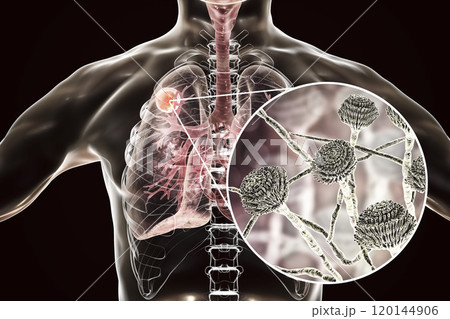 Aspergilloma of the lung and close-up view of Aspergillus fungi 120144906