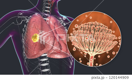 Pulmonary aspergillosis, invasion of a lung tissue by mold fungi Aspergillus with closeup view of the fungi, 3D illustration Pulmonary aspergillosis, invasion of a lung tissue by mold fungi Aspergillus with closeup view of the fungi, 3D illustration 120144909