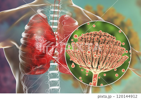 Pulmonary aspergillosis, invasion of a lung tissue by mold fungi Aspergillus with closeup view of the fungi, 3D illustration 120144912