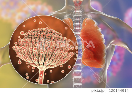 Pulmonary aspergillosis, invasion of a lung tissue by mold fungi Aspergillus with closeup view of the fungi, 3D illustration 120144914