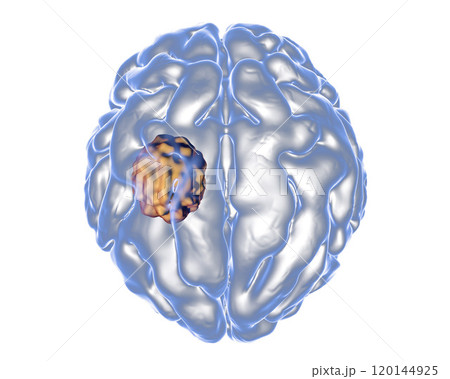 Aspergilloma of the brain 120144925