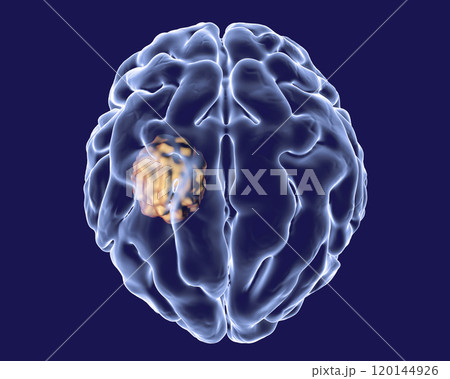 Aspergilloma of the brain 120144926