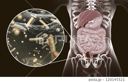 Acute appendicitis illustration Acute appendicitis illustration 120145521