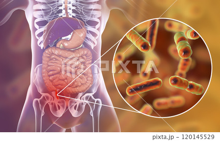 Acute appendicitis illustration 120145529