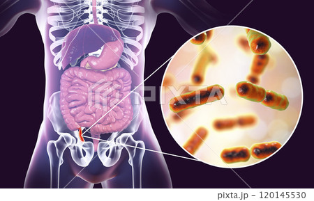 Acute appendicitis illustration Acute appendicitis illustration 120145530