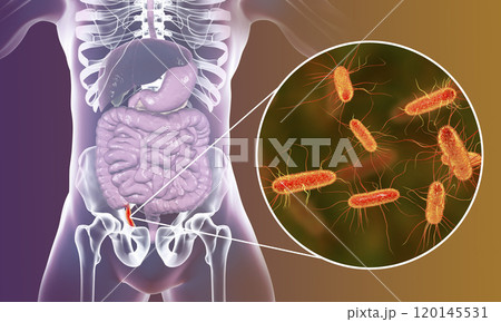 Acute appendicitis illustration Acute appendicitis illustration 120145531