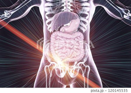 Acute appendicitis illustration Acute appendicitis illustration 120145535
