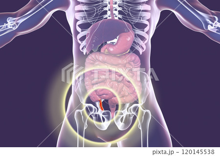Acute appendicitis illustration Acute appendicitis illustration 120145538